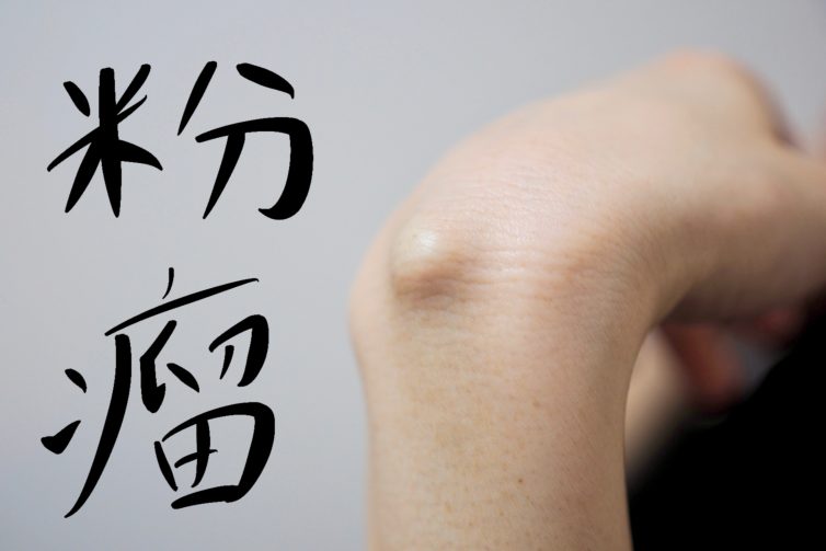 胸にできた大きなニキビ 粉瘤 初めての手術に挑んだ話